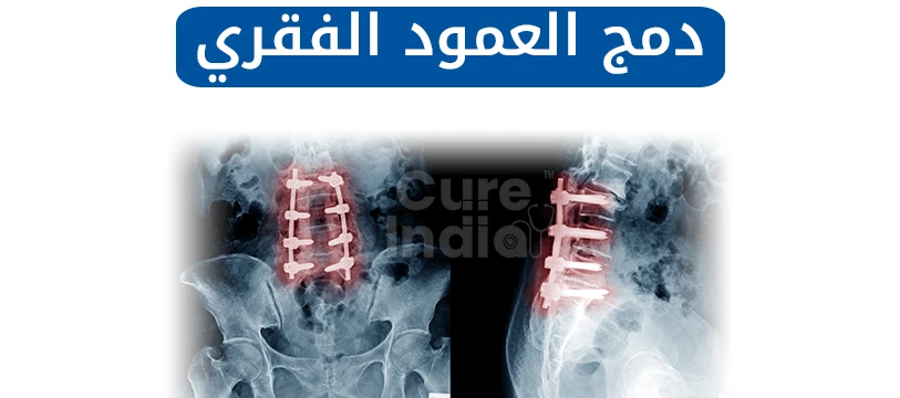 جراحة دمج العمود الفقري في الهند